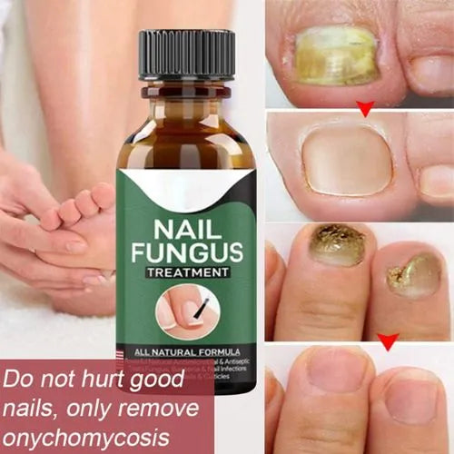 Nail Fungas Serum